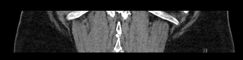 File:Buried bumper syndrome - gastrostomy tube (Radiopaedia 63843-72575 Coronal Inject 88).jpg