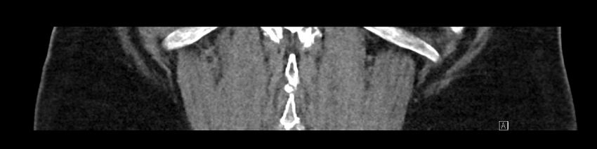 Buried bumper syndrome - gastrostomy tube (Radiopaedia 63843-72575 Coronal Inject 88).jpg
