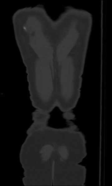 File:Burst fracture (Radiopaedia 83168-97542 Coronal bone window 71).jpg