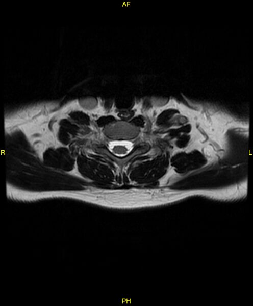File:C5 nerve sheath tumor (Radiopaedia 85777-101596 Axial T2 63).jpg
