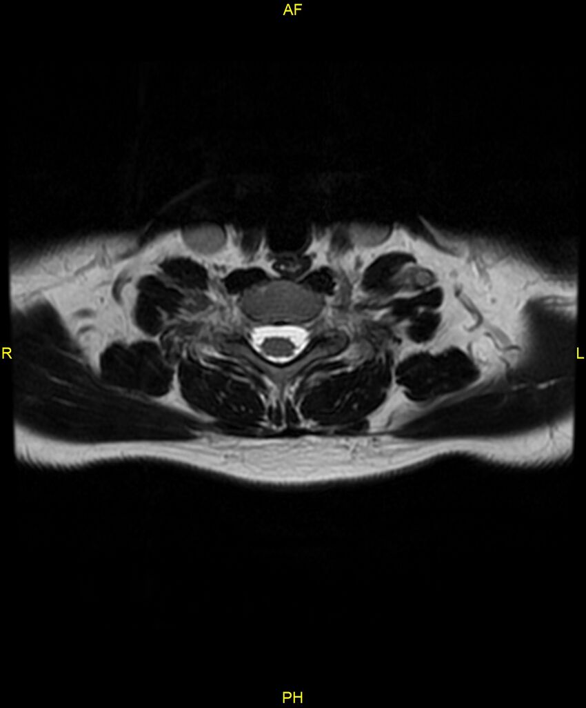 C5 nerve sheath tumor (Radiopaedia 85777-101596 Axial T2 63).jpg