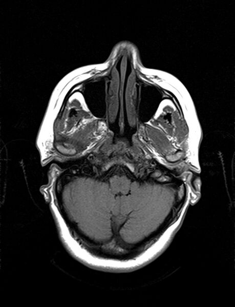 File:Calcified cerebral hydatid cyst (Radiopaedia 65603-74699 Axial T1 4).jpg