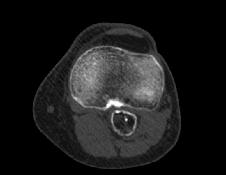File:Calcified hematoma - popliteal fossa (Radiopaedia 63938-72763 Axial bone window 40).jpg