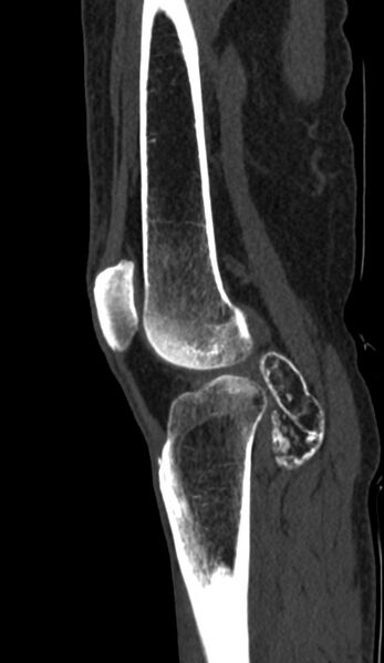 File:Calcified hematoma - popliteal fossa (Radiopaedia 63938-72763 Sagittal bone window 71).jpg