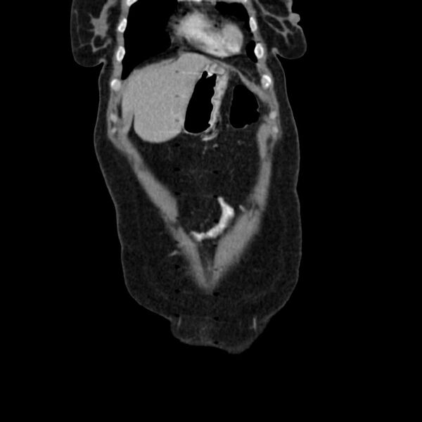File:Calcified hydatid cyst of the liver (Radiopaedia 21212-21112 D 3).jpg