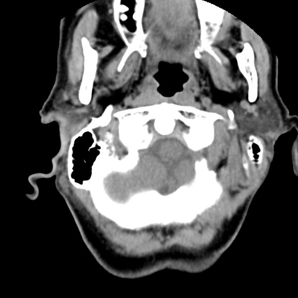 File:Calcified meningioma - cervical canal (Radiopaedia 70136-80171 B 3).jpg