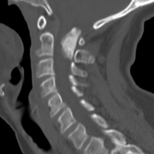 File:Calcified meningioma - cervical canal (Radiopaedia 70136-80171 Sagittal bone window 21).jpg
