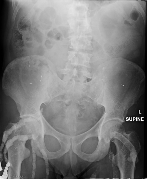 File:Calcified occluded femoral grafts in a renal transplant patient (Radiopaedia 36546-38110 Frontal 1).png