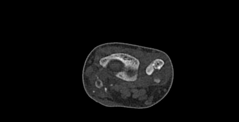 File:Calcifying aponeurotic fibroma (Radiopaedia 88423-105064 Axial bone window 38).jpg