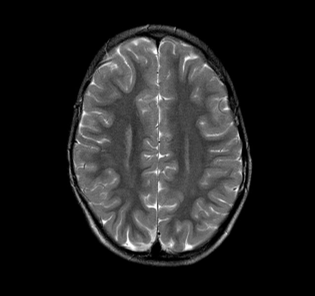 File:Callosal dysgenesis and ectopic posterior pituitary (Radiopaedia 8382-9213 Axial T2 2).jpg