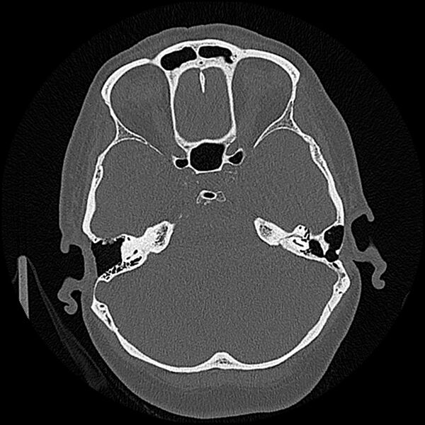 File:Canal up mastoidectomy (Radiopaedia 78108-90638 Axial bone window 95).jpg