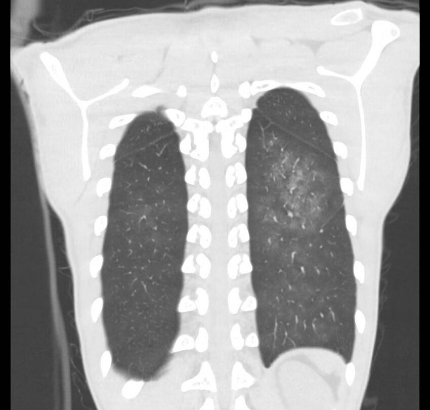 Cannabis-induced diffuse alveolar hemorrhage (Radiopaedia 89834-106946 Coronal lung window 14).jpg
