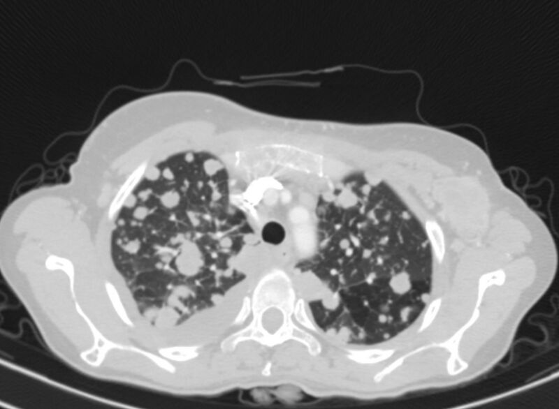 File:Cannonball metastases from breast cancer (Radiopaedia 91024-108569 Axial lung window 19).jpg
