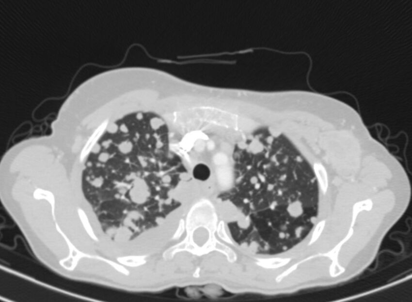 Cannonball metastases from breast cancer (Radiopaedia 91024-108569 Axial lung window 19).jpg