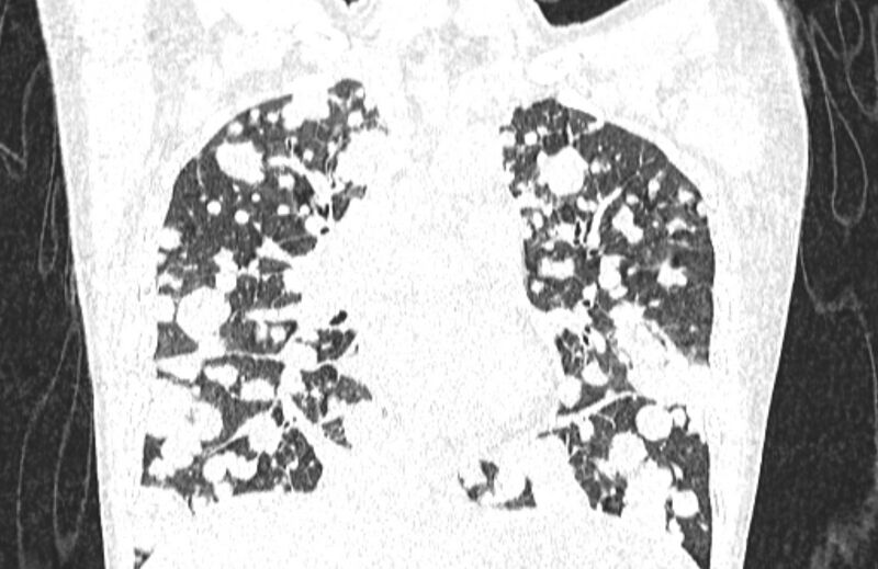 File:Cannonball metastases from breast cancer (Radiopaedia 91024-108569 Coronal lung window 69).jpg
