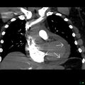 Cardiac tamponade (Radiopaedia 20909-20841 C+ arterial phase 1).jpg