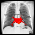 Cardiomediastinal anatomy on chest radiography (annotated images) (Radiopaedia 46331-50742 Q 5).png
