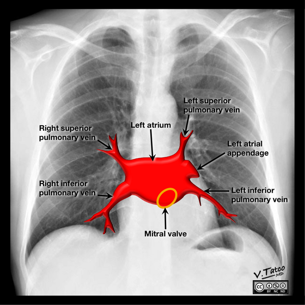 File:Cardiomediastinal anatomy on chest radiography (annotated images) (Radiopaedia 46331-50742 Q 5).png