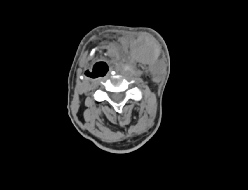 Carotid artery pseudoaneurysm (Radiopaedia 84030-99259 Axial non-contrast 21).jpg