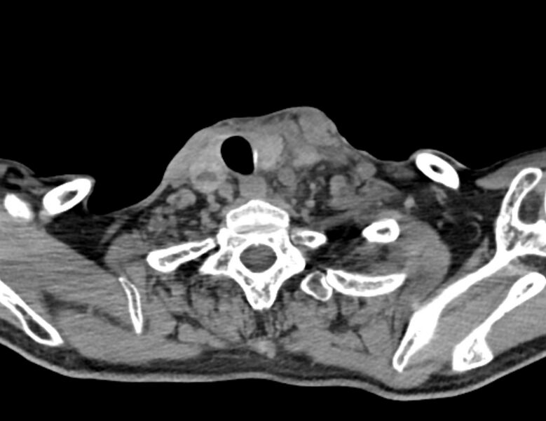 File:Carotid artery pseudoaneurysm (Radiopaedia 84030-99259 Axial non-contrast 48).jpg