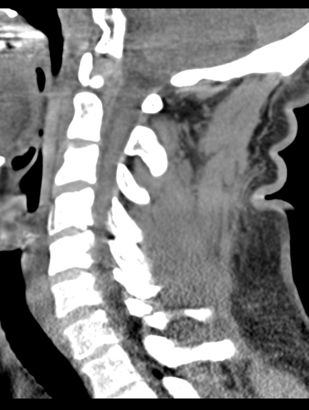 File:Cavernoma of cervical cord (Radiopaedia 50838-56346 B 45).png