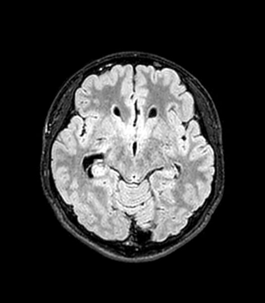 File:Central neurocytoma (Radiopaedia 79320-92380 Axial FLAIR 183).jpg