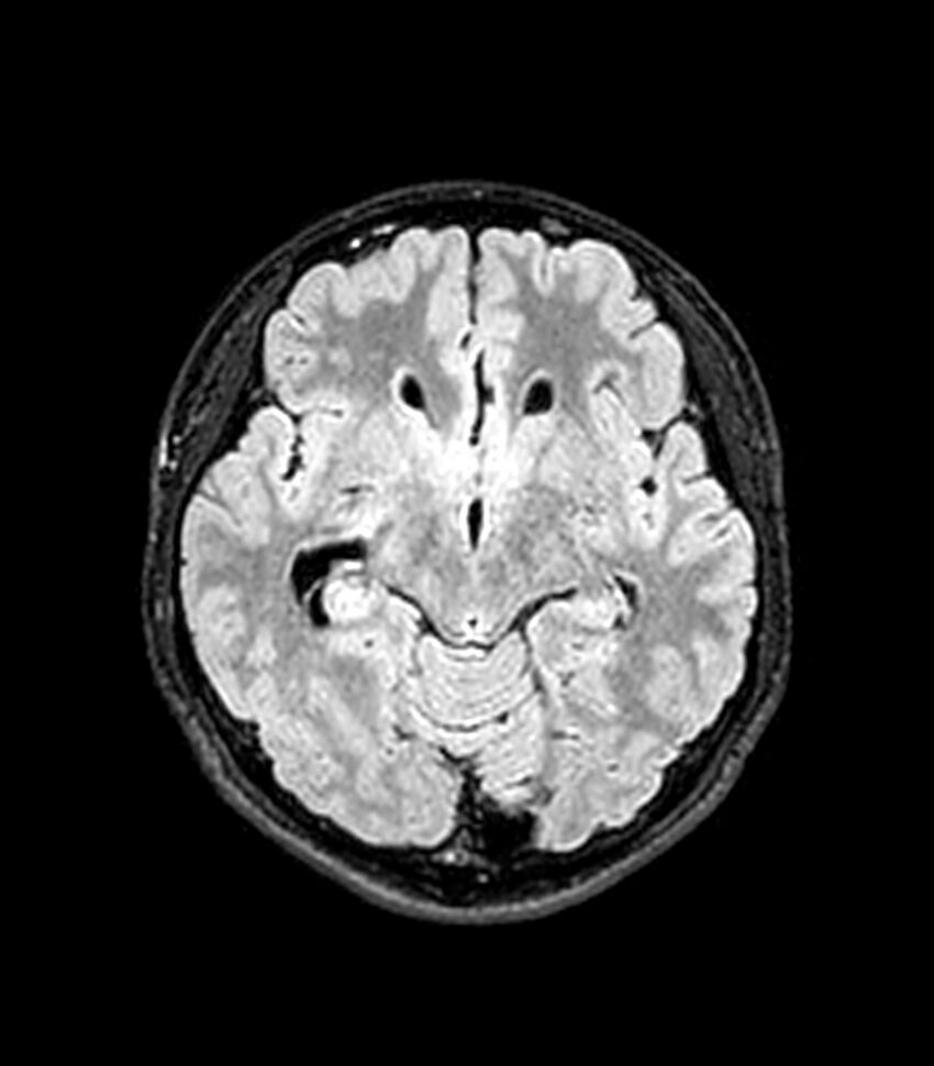 Central neurocytoma (Radiopaedia 79320-92380 Axial FLAIR 183).jpg