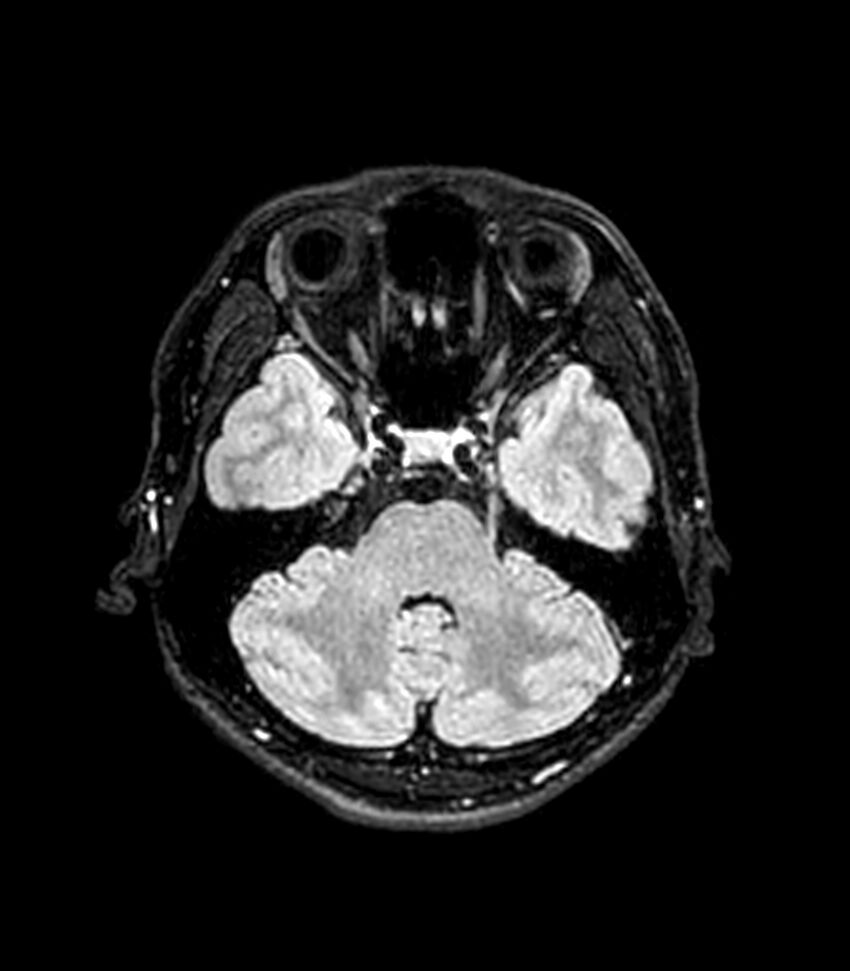 Central neurocytoma (Radiopaedia 79320-92380 Axial FLAIR 221).jpg