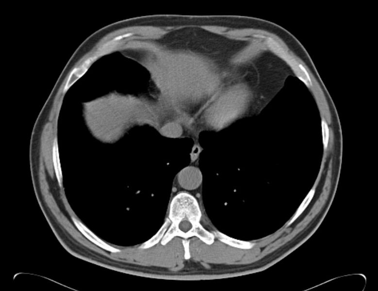 File:Centrilobular pulmonary emphysema (Radiopaedia 26808-26971 Axial non-contrast 34).jpg