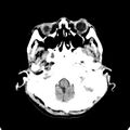 Cerebellar abscess secondary to mastoiditis (Radiopaedia 26284-26412 Axial non-contrast 19).jpg