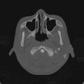 Cerebellar abscess secondary to mastoiditis (Radiopaedia 26284-26413 Axial bone window 8).jpg