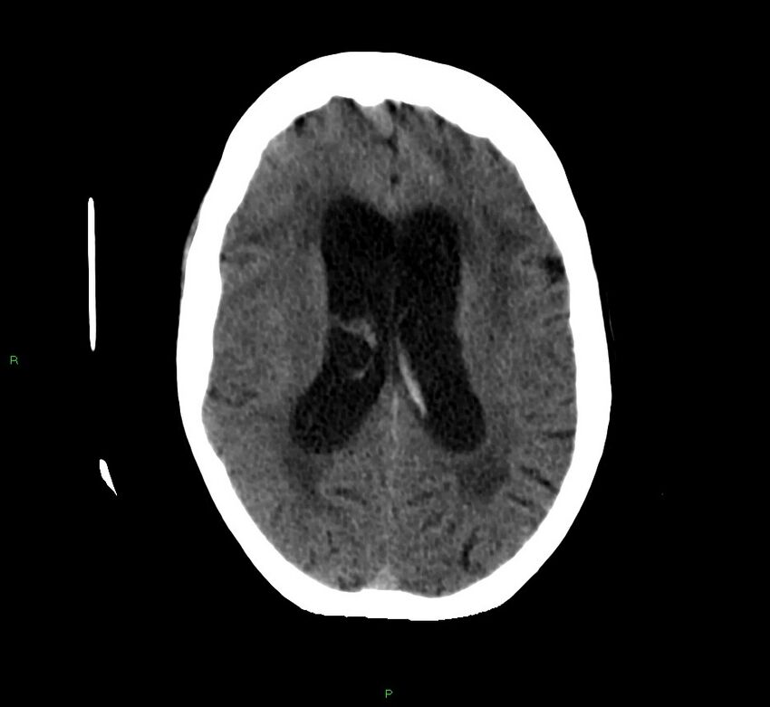 Cerebellar hemorrhage (Radiopaedia 58792-66026 Axial non-contrast 21).jpg