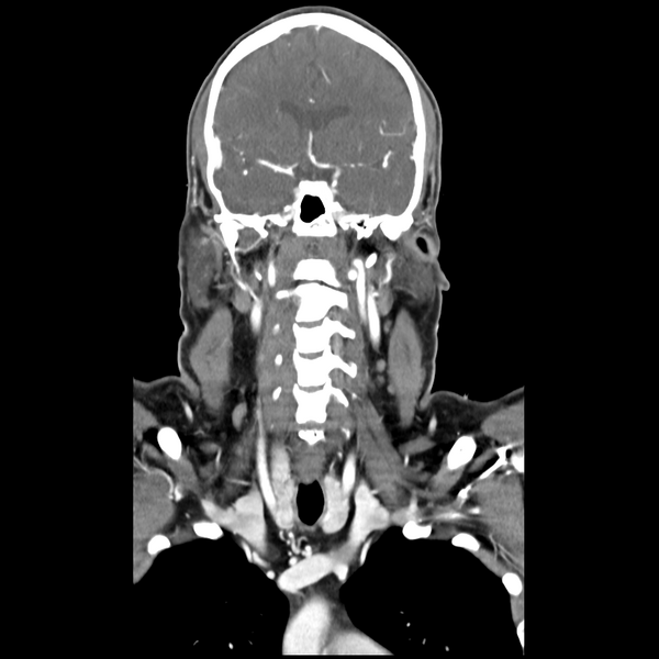 File:Cerebellar infarct due to vertebral artery dissection with posterior fossa decompression (Radiopaedia 82779-97029 D 28).png