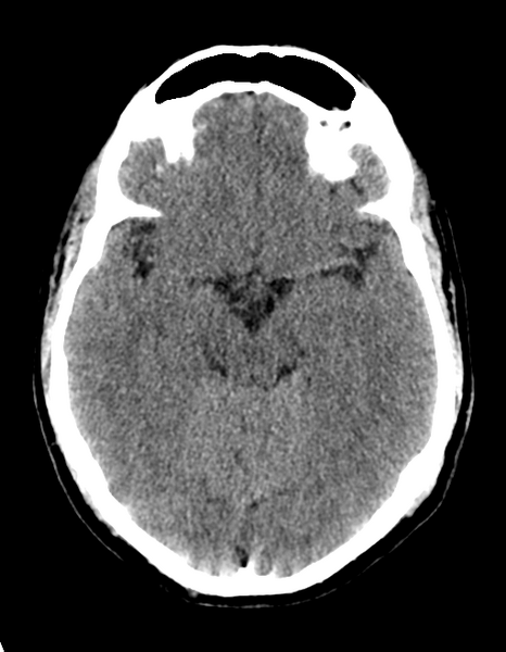 File:Cerebellar infarct due to vertebral artery dissection with posterior fossa decompression (Radiopaedia 82779-97030 Axial non-contrast 14).png