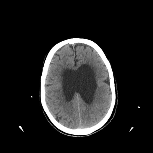 File:Cerebellar metastasis - lung tumor (Radiopaedia 69317-79145 Axial non-contrast 26).jpg
