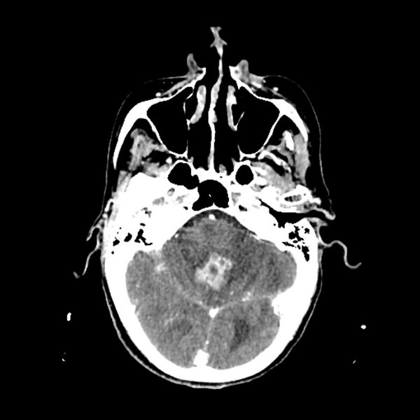 File:Cerebellar metastasis - lung tumor (Radiopaedia 69317-79145 Axial with contrast 12).jpg