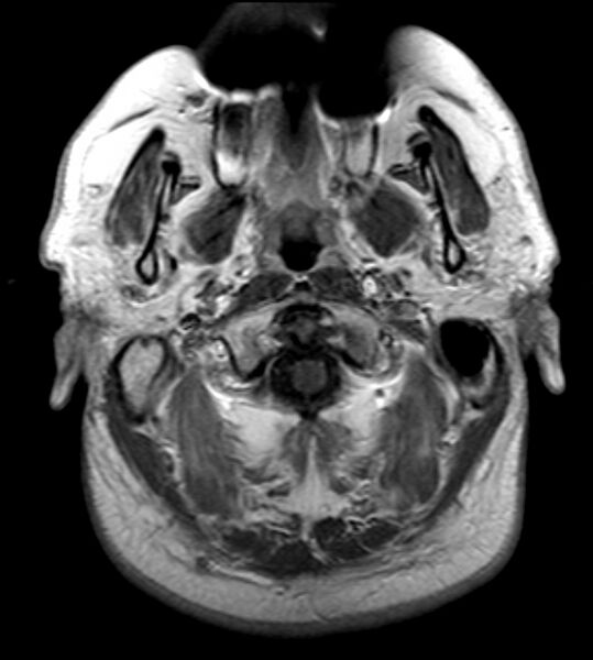 File:Cerebellopontine angle meningioma (Radiopaedia 24459-24764 Axial T1 C+ 1).jpg