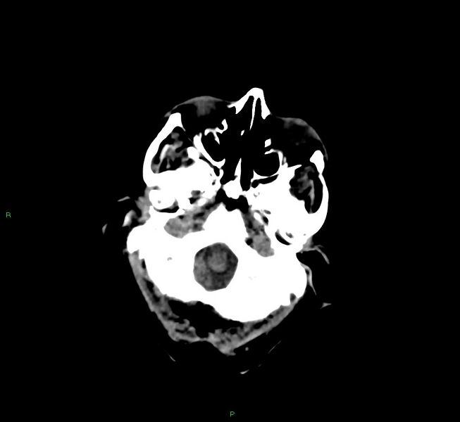File:Cerebral amyloid angiopathy-associated lobar intracerebral hemorrhage (Radiopaedia 58377-65514 Axial non-contrast 43).jpg