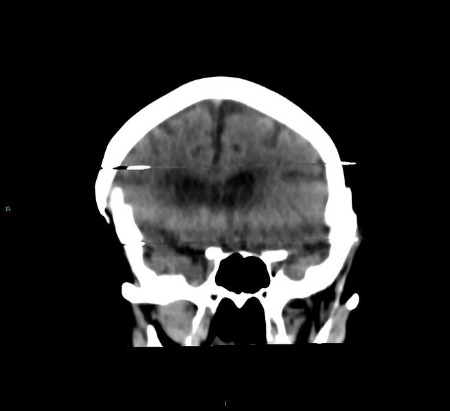 File:Cerebral amyloid angiopathy-associated lobar intracerebral hemorrhage (Radiopaedia 58377-65514 Coronal non-contrast 44).jpg