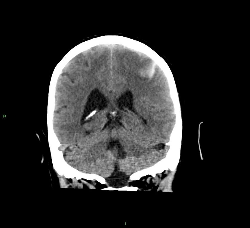 Cerebral amyloid angiopathy-associated lobar intracerebral hemorrhage (Radiopaedia 58529-65681 Coronal non-contrast 25).jpg