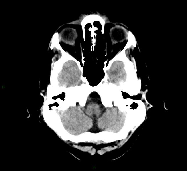 File:Cerebral amyloid angiopathy-associated lobar intracerebral hemorrhage (Radiopaedia 58529-65687 Axial non-contrast 42).jpg