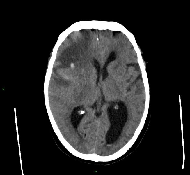 File:Cerebral amyloid angiopathy-associated lobar intracerebral hemorrhage (Radiopaedia 58560-65723 Axial non-contrast 28).jpg