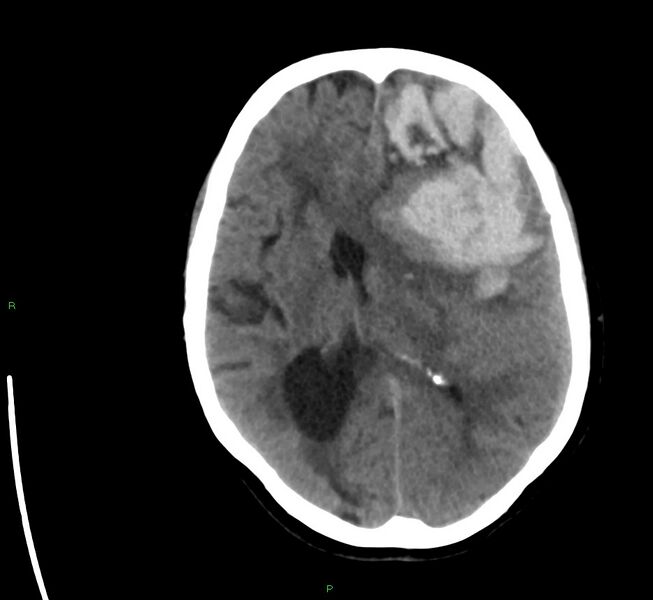 File:Cerebral amyloid angiopathy-associated lobar intracerebral hemorrhage (Radiopaedia 58561-65724 Axial non-contrast 22).jpg