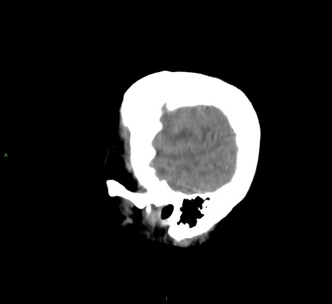 File:Cerebral amyloid angiopathy-associated lobar intracerebral hemorrhage (Radiopaedia 58756-65977 C 9).jpg