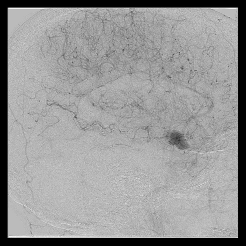Cerebral aneurysm with rupture (Radiopaedia 29933-30458 LT CCA IC 44).jpg