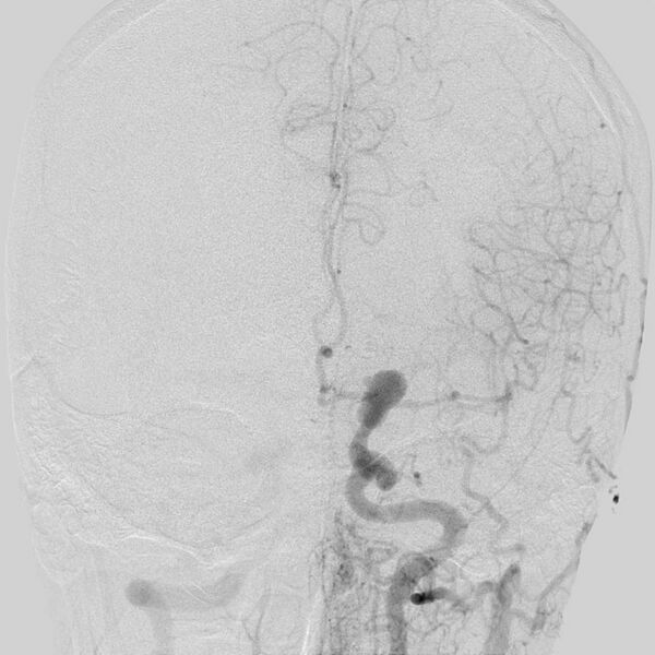 File:Cerebral aneurysm with rupture (Radiopaedia 29933-30458 LT ICA IC 16).jpg