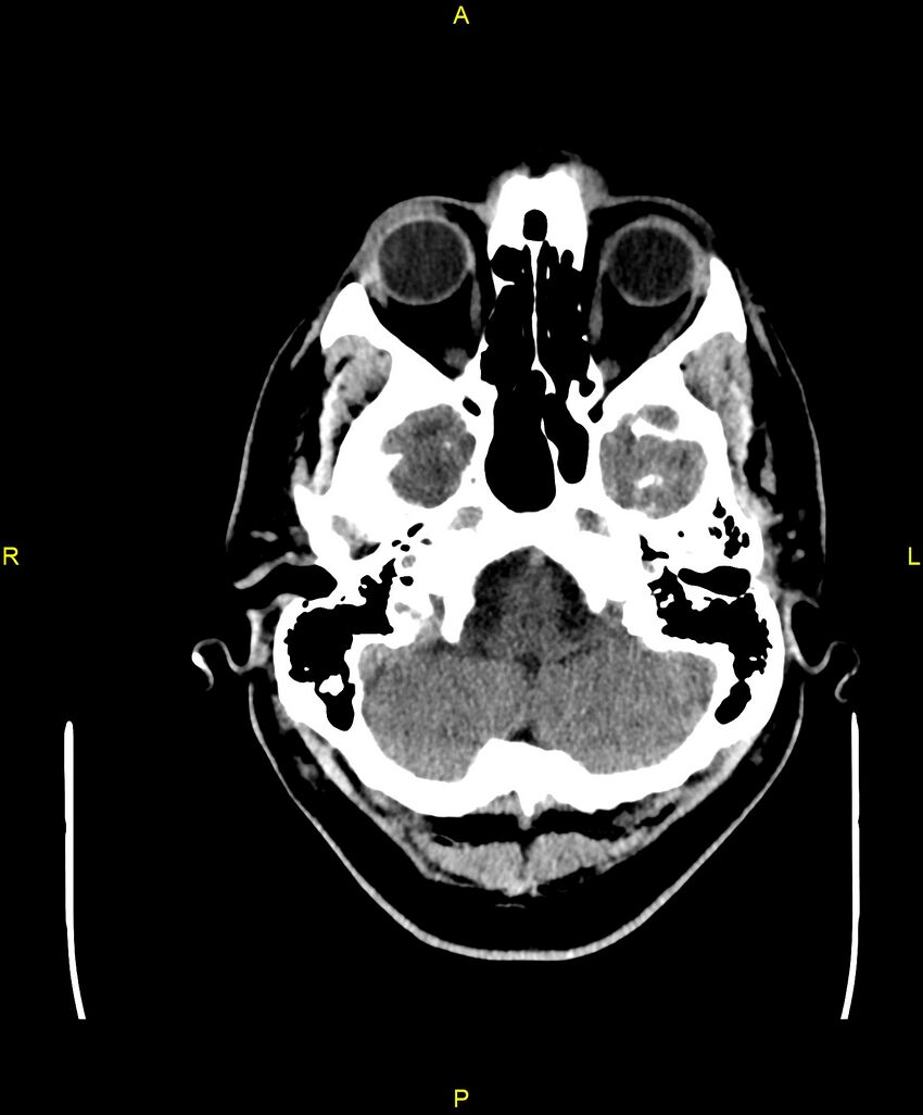 Cerebral autosomal dominant arteriopathy with subcortical infarcts and leukoencephalopathy (CADASIL) (Radiopaedia 86108-102051 Axial non-contrast 16).jpg