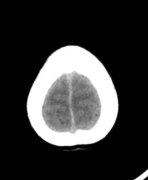 File:Cerebral edema due to severe hyponatremia (Radiopaedia 89826-106937 Axial non-contrast 85).jpg