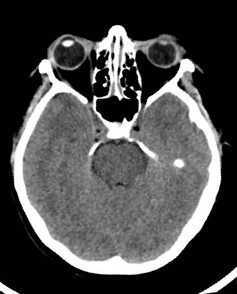 File:Cerebral edema due to severe hyponatremia (Radiopaedia 89826-106938 Axial non-contrast 36).jpg