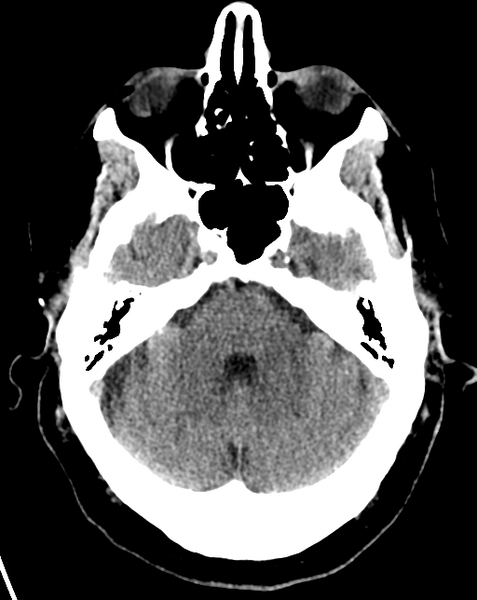File:Cerebral embolic infarcts (embolic shower) (Radiopaedia 57395-64341 Axial non-contrast 9).png